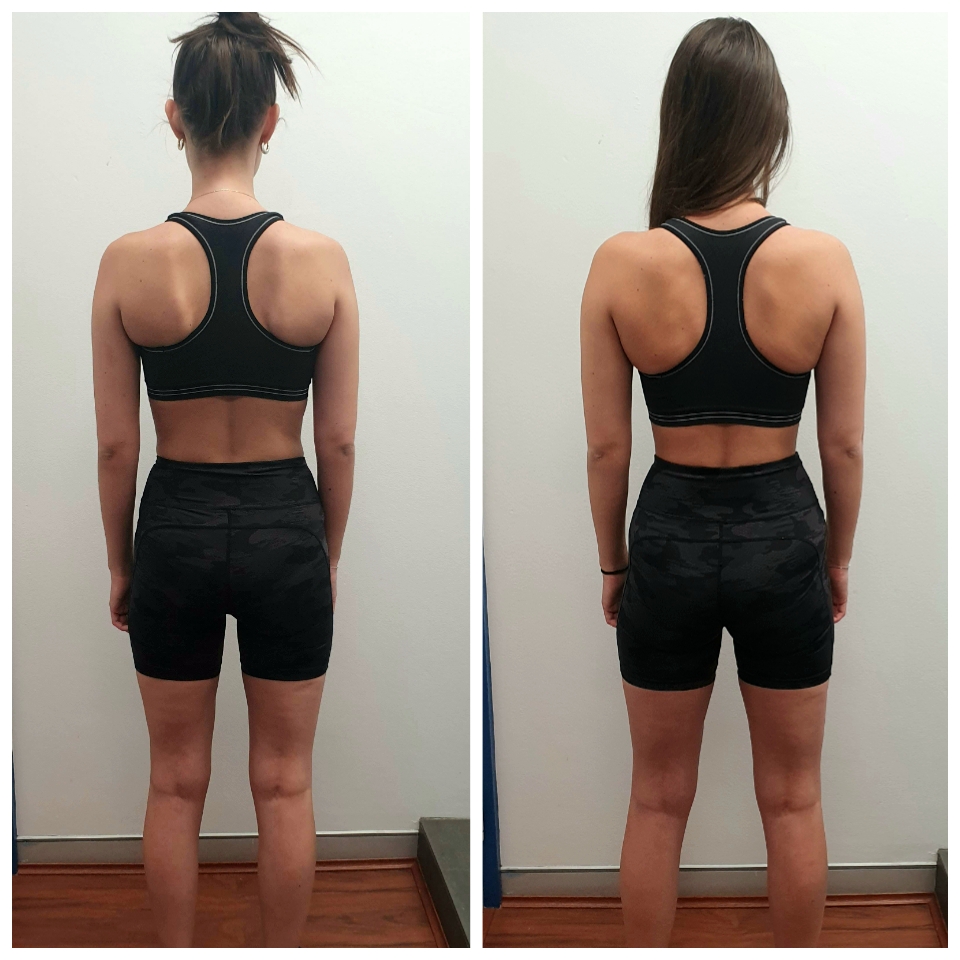 Daniella scapula posture and spine alignment progress